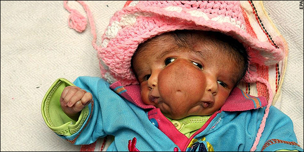 В Индии родилась девочка с двумя лицами