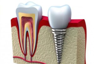 5 плюсов зубных имплантов