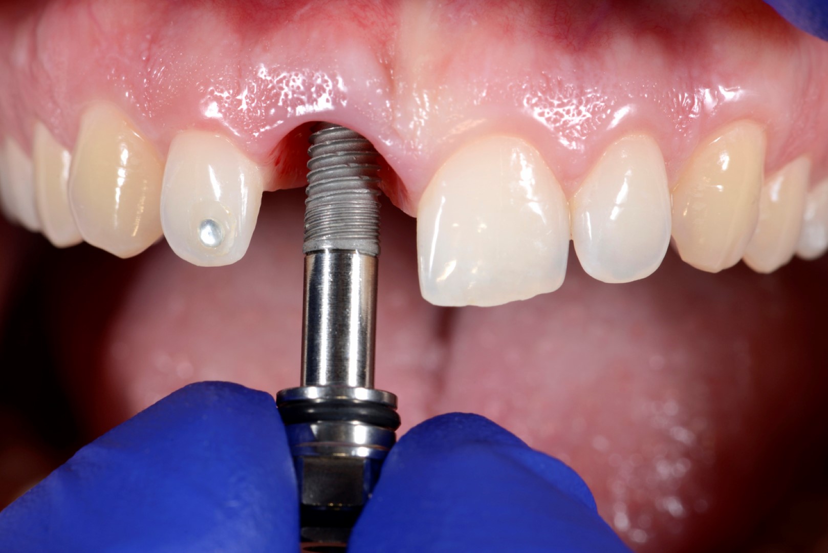 Имплантация зубов: эффективное решение для восстановления улыбки